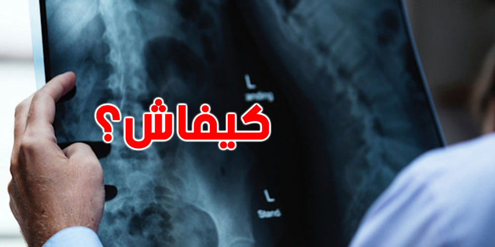 ربع التوانسة بعد الأربعين مهدّدين بتآكل غضروف الركبة!